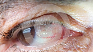 Eye of an elderly man with cataracts, clouding of the lens, macro video.