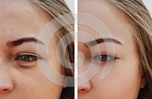 Eye girl bag under the eyes removal before and after treatment cosmetic procedures