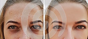 Eye girl bag under the eyes before and after treatment cosmetic procedures photo