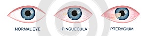 Eye healthy, with pinguecula and pterygium growing onto cornea. Conjunctival degeneration. Eye disease. Human organ of photo