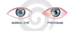 Eye healthy and with pterygium. Conjunctival degeneration before and after surgery. Eye disease. Human organ of vision