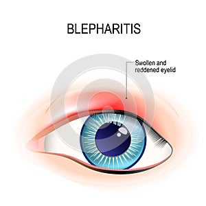 Eye of human. Blepharitis. inflammation of the eyelid photo