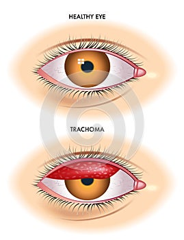 Eye infected with trachoma
