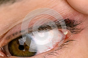 Eye infection disease known as stye