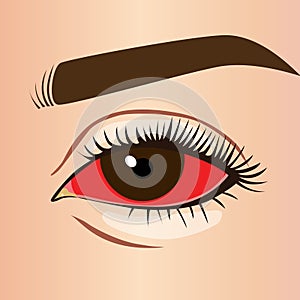 Eye inflammation bloodshot or conjunctivitis, illustration