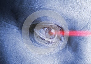 Eye laser operation photo