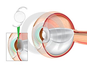 Eye Lens Replacement Surgery. Lens Implant. Cataract Surgery. Intraocular Lenses IOL.