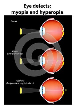 Eye optical defects : myopia and hyperopia. vector photo