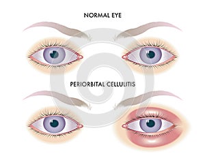 Eye with periorbital cellulitis photo