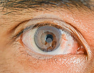 Eye pterygium in man photo