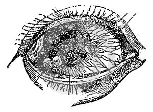 Eye with Pustular Conjunctival Keratitis, vintage engraving photo