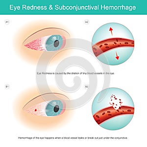 Eye Redness & Subconjunctival Haemorrhage.