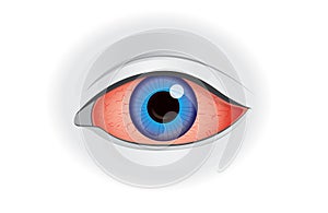 Eye redness symptom of human on white.