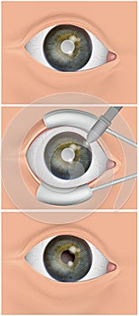 The eye's natural lens replaced with an artificial intraocular lens IOL . Cataract surgery, also called lens