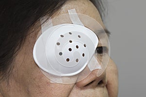 Eye shield covering after cataract surgery.