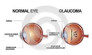 Eye structure. Anatomy of an eye defect, Glaucoma
