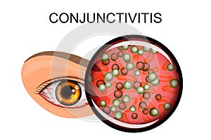 Eye suffering from conjunctivitis and styes photo