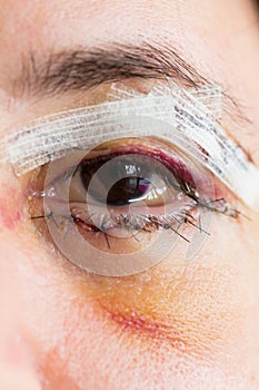 Eye after surgery, blepharoplasty