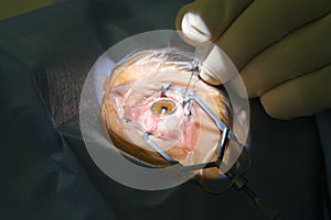 Eye Surgery