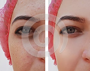 Eye swelling, wrinkles before and after cosmetic pigmentation procedure