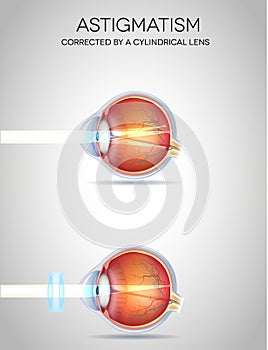 Eye vision disorders