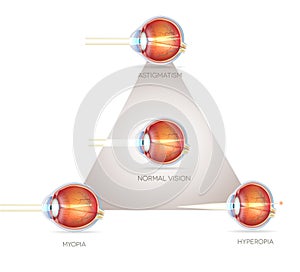 Eye vision triangle