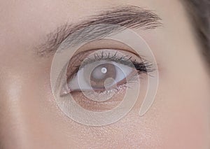 Eye of a woman with cataract photo