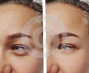 Eye wrinkles young woman before and after closeup cosmetology procedures