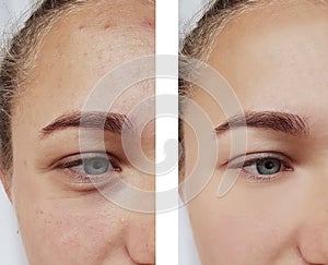 Eye wrinkles young woman before and after cosmetology procedures