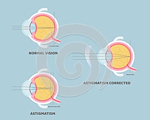 Eyeball anatomy, internal organs body part nervous system, astigmatism corrected, eyesight concept photo