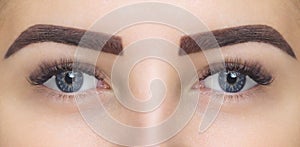 Eyelash removal procedure close up.
