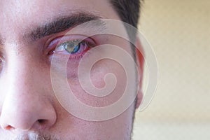 Eyelid abscess