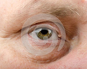 Eyelid cyst picture photo