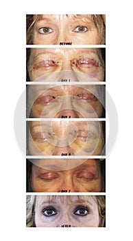 Eyelid Surgery