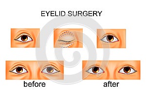 Eyelid surgery, plastic surgery photo