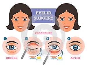 Eyelid surgery procedure before after illuatration with main steps. Excess skin and fat removal.