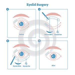 Eyelid surgery procedure scheme illustration. Excess skin and fat removal plastic surgery. Women fashion simple line style design. photo