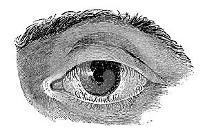 Eyelids with inwardly thinned eyelashes Trichasis.