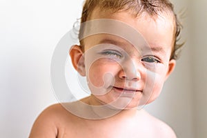Eyes of a baby with bacterial purulence conjunctivitis