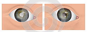 Eyes before and after cataract removal with and without problem. Cataracts and healthy eye.