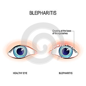 Eyes of human. Blepharitis. Crusting at the eyelid margins