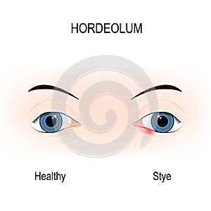 Eyes of human. stye. external hordeolum of lower eyelid.