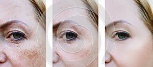 Eyes woman face wrinkles pigmentation , lifting patient before and after procedures health