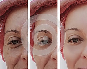 Eyes woman face wrinkles, patient before and after procedures health