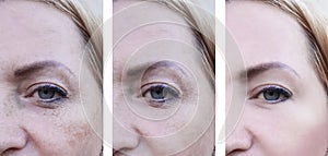 Eyes woman face wrinkles pigmentation , patient before and after procedures health