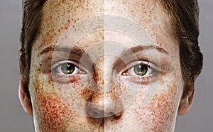 Eyes Woman freckle happy young beautiful studio portrait with healthy skin half