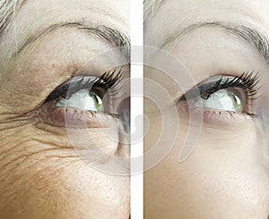 eyes of a woman`s wrinkles, before after procedures rejuvenation procedures treatments results