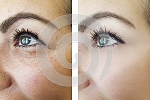 Eyes of a woman wrinkles before and after, procedures bloating