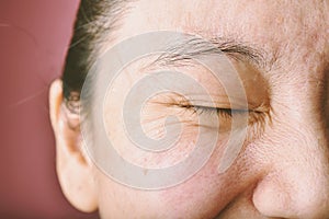 Eyes wrinkle, Facial skin problem, Aging problem in adult, acne scar, large pore and dark spot