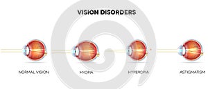 Eyesight disorders